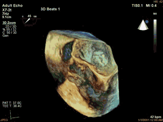 周浦医院 3D-TEE辅助评估左心耳封堵病例