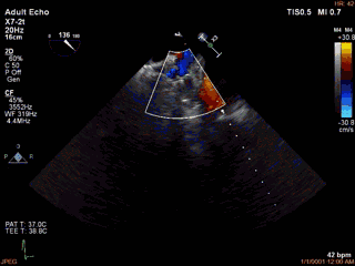 周浦医院 3D-TEE辅助评估左心耳封堵病例