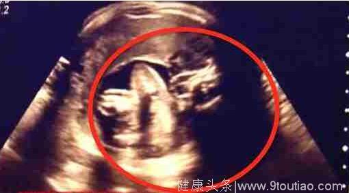 孕妈产下寄生胎 新生女婴肚子里还有一个婴儿！医生都惊住了！