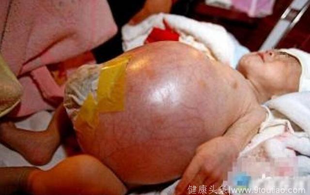 孕妈产下寄生胎 新生女婴肚子里还有一个婴儿！医生都惊住了！