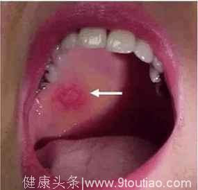 口腔溃疡，伴随舌头肿大，警惕是舌癌