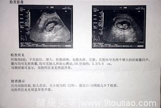 孕期里面如果有这3大症状，那么恭喜你，很有可能是双胞胎哦