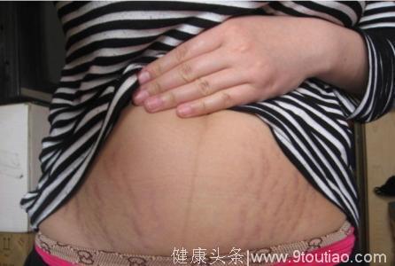 医生分析妊娠纹出现的原理，原来这样做可以预防妊娠纹！