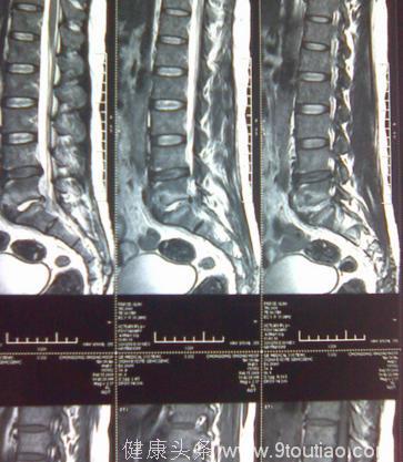 脊柱肿瘤手术后护理应该怎么做？