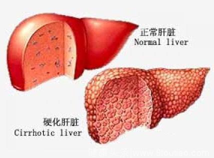 肝硬化早期治疗 恢复肝脏功能