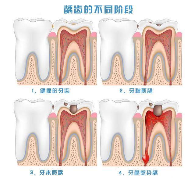 牙齿里边有这样一个垃圾场，没有口臭才奇怪！