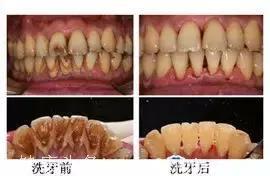 洗牙会导致牙缝变大？