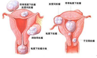 有生育要求的子宫肌瘤手术治疗