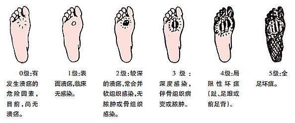 南京4万人因糖尿病面临或正经历“截肢”，你可了解糖尿病足的严重性？