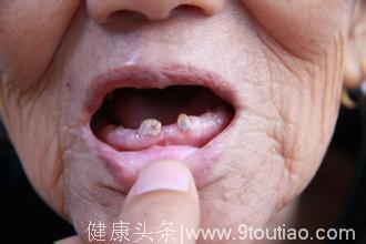 女子口腔溃疡反复3 年，医院检查需要割舌头