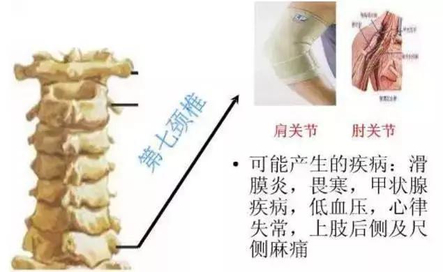 详细图解脊椎（颈椎、胸椎、腰椎）可能引起的108种疾病，太全面了，强烈建议收藏