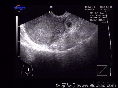 怀孕6个月忽觉腹部剧烈疼痛，却被医生告知肚子里没有孩子！