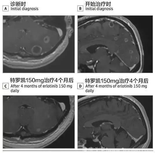 脑转移的肺癌患者应该推迟靶向用药治疗吗？