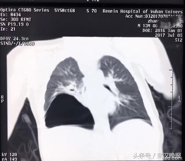 出生后反复感冒咳嗽 13月大男婴竟被巨瘤占据大半个肺