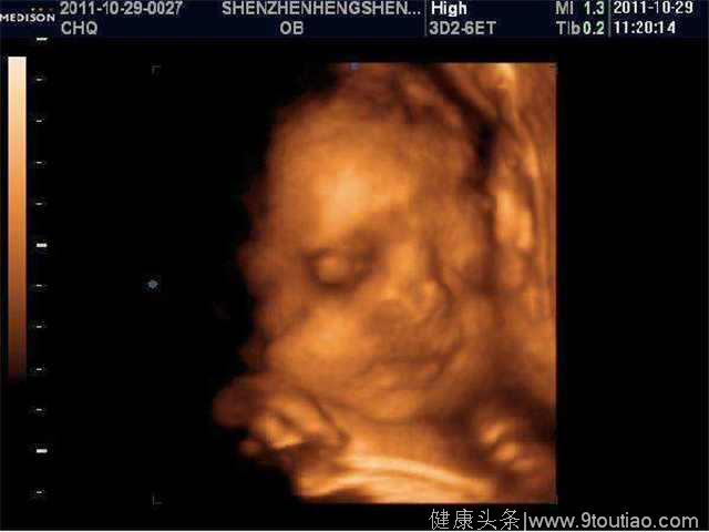 四维彩超显示胎儿畸形，只因准妈妈在孕期做了这两件事情