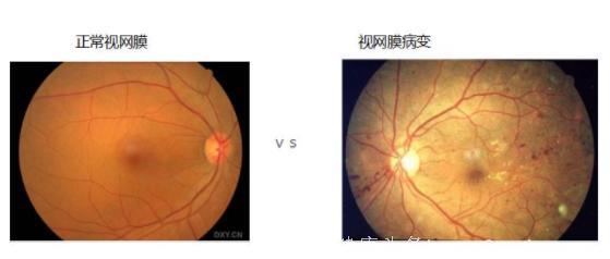 糖尿病视网膜病变正危害着我们的眼睛，严重会致盲！