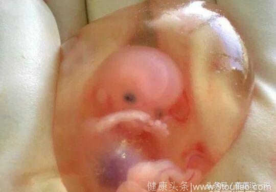 胎儿被医生宣布放弃，他从子宫伸出手抓住医生！他为自己争取了活下来的机会！