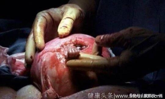 胎儿被医生宣布放弃，他从子宫伸出手抓住医生！他为自己争取了活下来的机会！
