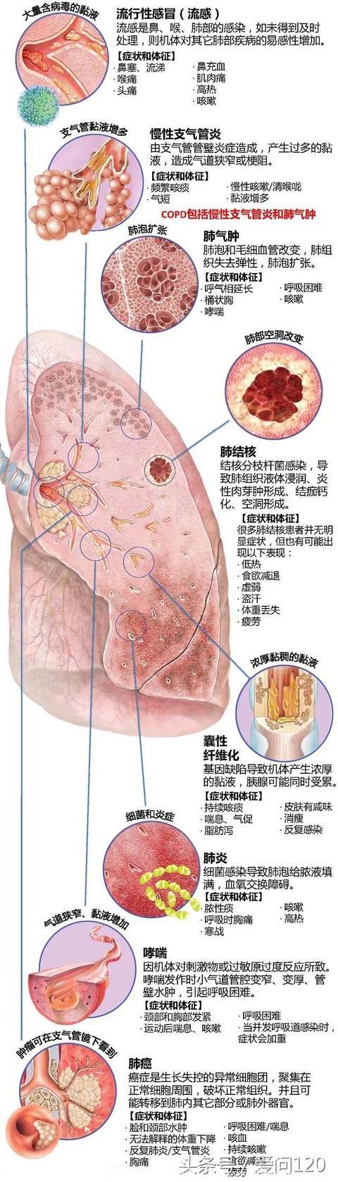 慢性支气管炎的症状及表现，如何与支气管扩张、哮喘、肺结核、肺癌鉴别？