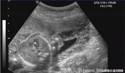 24周大排畸：胎儿左心室有强光点，是心脏病吗？产检一波三折，这种焦虑只有准妈妈自己知道