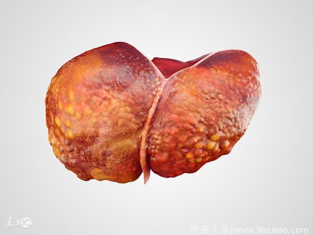 脂肪肝到肝癌只有4步！这8种人危险了
