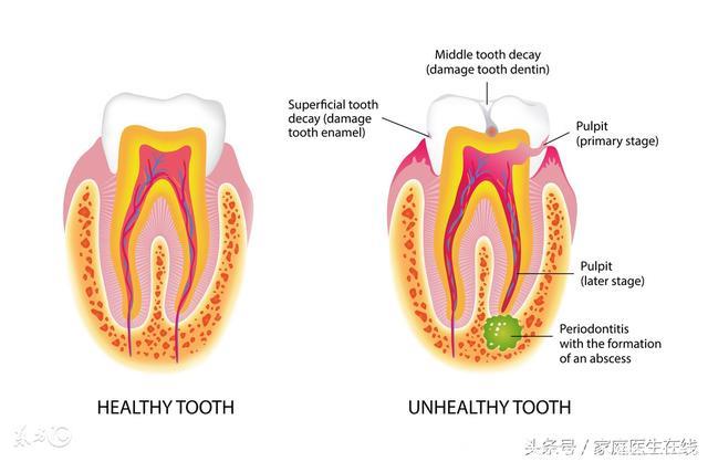 龋齿不补，会带来哪些危害？知道答案的人都沉默了