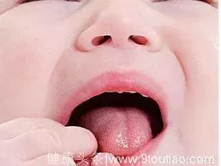 儿童口腔溃疡的原因和治疗方法