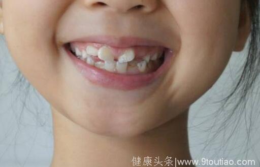 儿童牙医詹磊提醒家长：孩子吃得太精细会变丑！