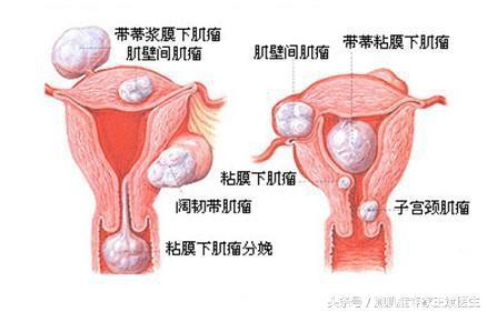 子宫腺肌症合并有子宫肌瘤该怎么办？