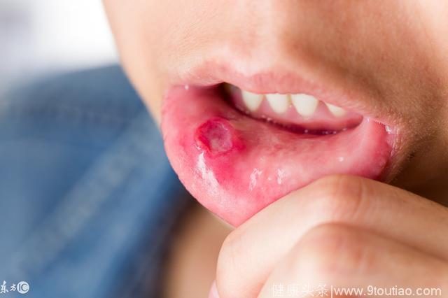 口腔溃疡能照出你五脏的毛病？
