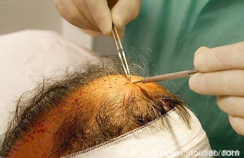 植发能解决脱发的根本问题吗？