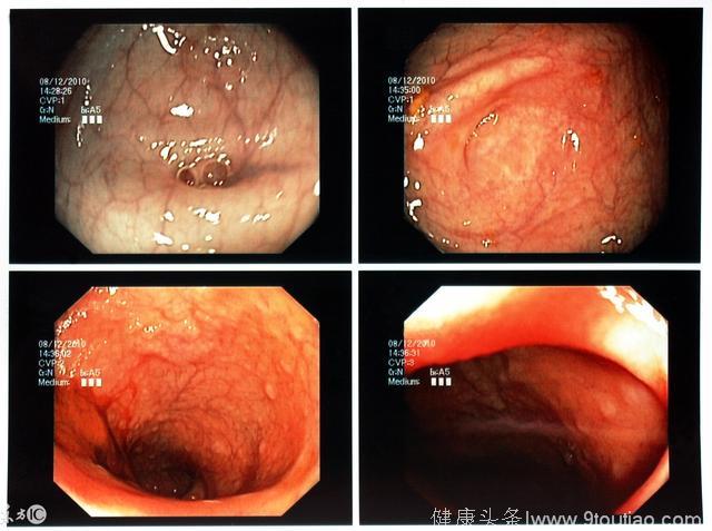5个症状一出现，可能是肠癌早期，这两件事，再难也要坚持！