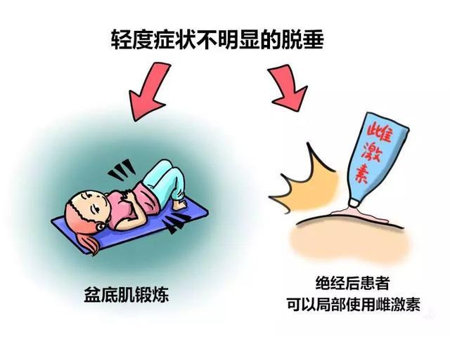 远离子宫脱垂，其实很简单！