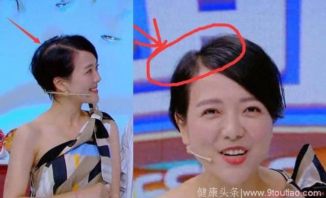 汪涵老婆杨乐乐严重脱发导致头顶空白一片！网友：孕妇脱发怎么办