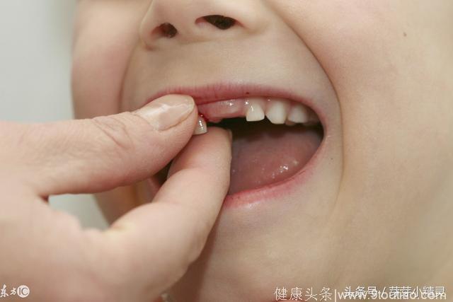 孩子乳牙外伤，隐藏在它下方的“恒牙胚”受伤才是最大的遗憾