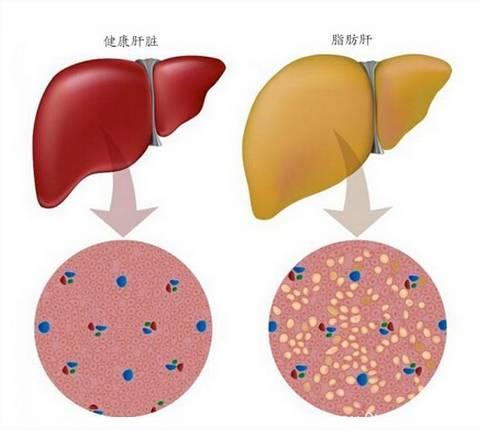 脂肪肝的5个关键控制因素及8个预防措施！