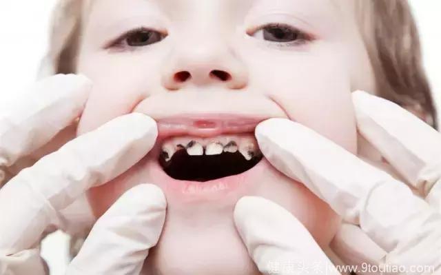 好好刷牙就能够预防蛀牙？并没有这么简单丨八大儿童口腔误区終篇