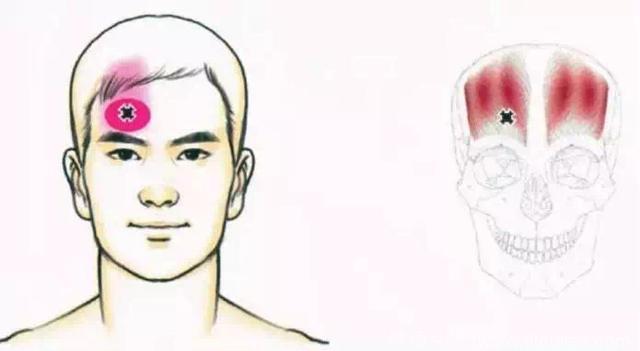 头疼的最最重要原因“颈源性头痛”简单粗暴的手法操作