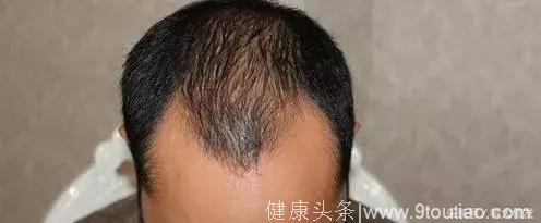 有一种脱发叫做“命中注定”，那就是遗传性脱发