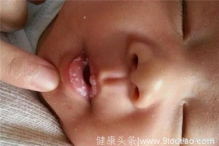 宝宝拒食口腔长有白色絮状物，当心是患了鹅口疮！
