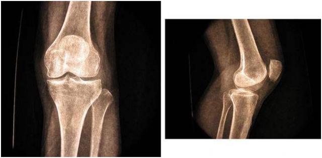 十个膝盖九个关节炎，其实使用这个方法就能慢慢好起来了，已验证