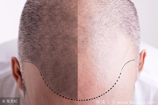 脱发是由于肾虚引起的吗？