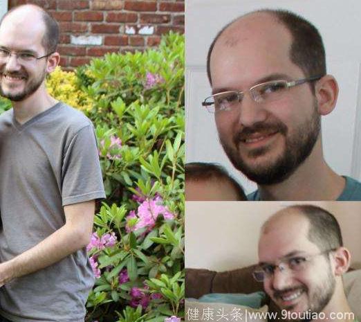 国外男子为治愈脱发，服用了过量雌激素，一年后变成了大美女