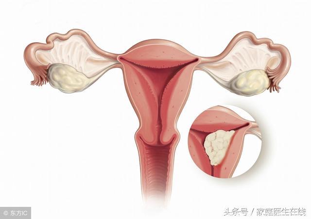 研究：这三种女人是子宫内膜癌的“候选人”，不是开玩笑！