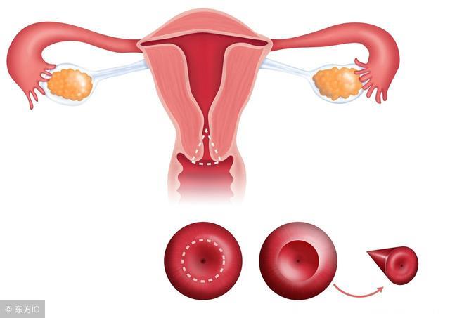 子宫内膜癌高危人群，3种女人是首选，快来看，你中招了吗？
