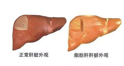脂肪肝放任不管会恶化！坚持两方面，可调养肝脏