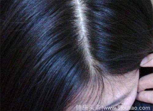经常脱发头发油，可能是头皮毛囊受损导致