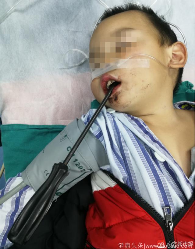 广州幼童家中玩耍跌倒 被50厘米螺丝刀插脑 幸未穿透颅底