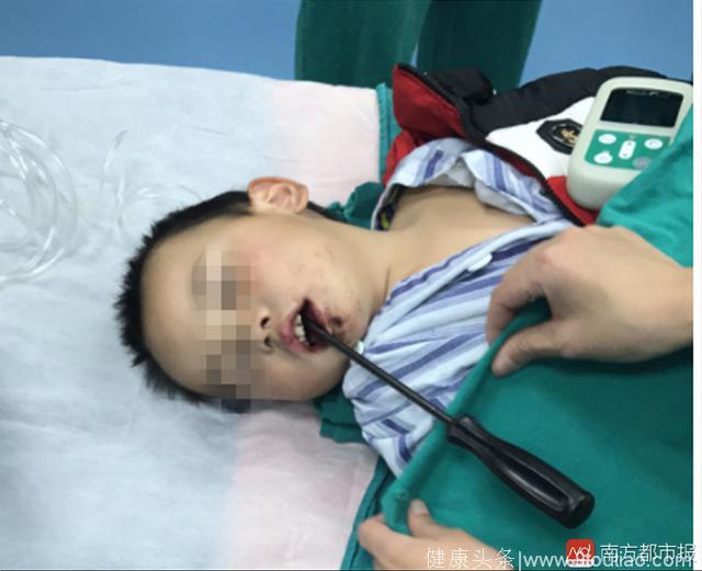 广州幼童家中玩耍跌倒 被50厘米螺丝刀插脑 幸未穿透颅底