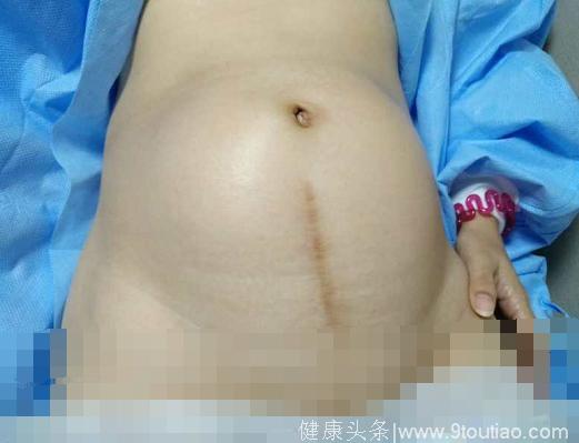 15cm的子宫肌瘤，除了切子宫还有什么办法？